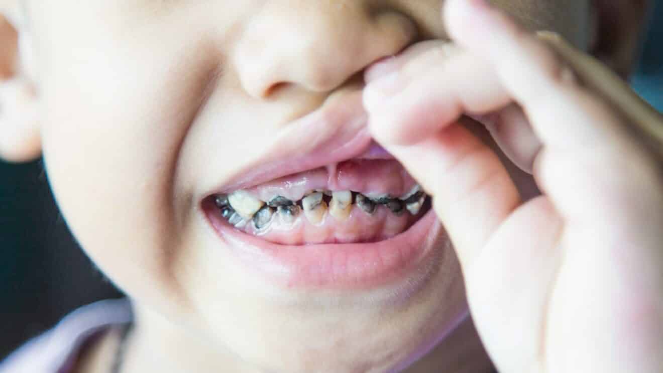 Karies bei Kindern-ein riesiges Problem
